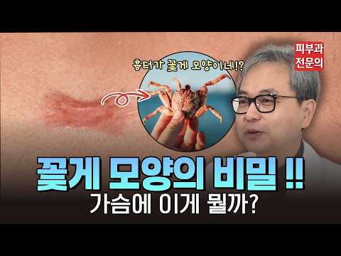유독 가슴 켈로이드가 더 딱딱하고 아픈 이유 (feat. 여드름과 켈로이드가 같이 있다면?)