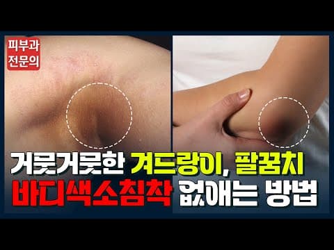 거뭇거뭇한 겨드랑이, 팔꿈치 색소침착에 대한 모든것! 이 영상으로 종결합니다!