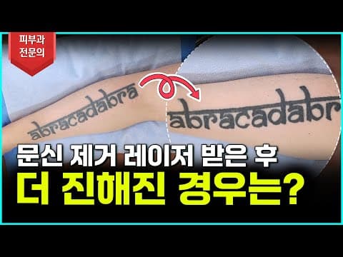 문신 제거 후 오히려 진해졌다고요? 분명한 이유가 있습니다