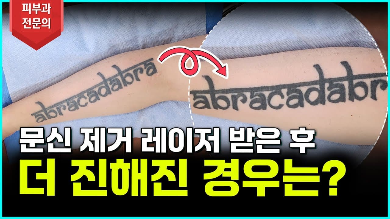 Tattoo Got Darker After Removal? There's a Specific Reason