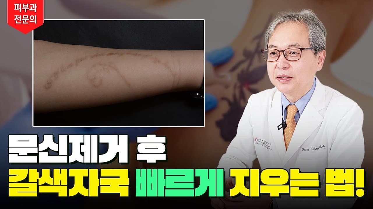 洗纹身的褐色印记 色素沉着 快速去除的小妙招