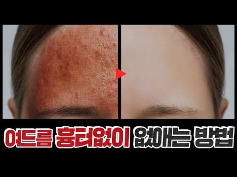 여드름 절대 이렇게 짜지 마세요!