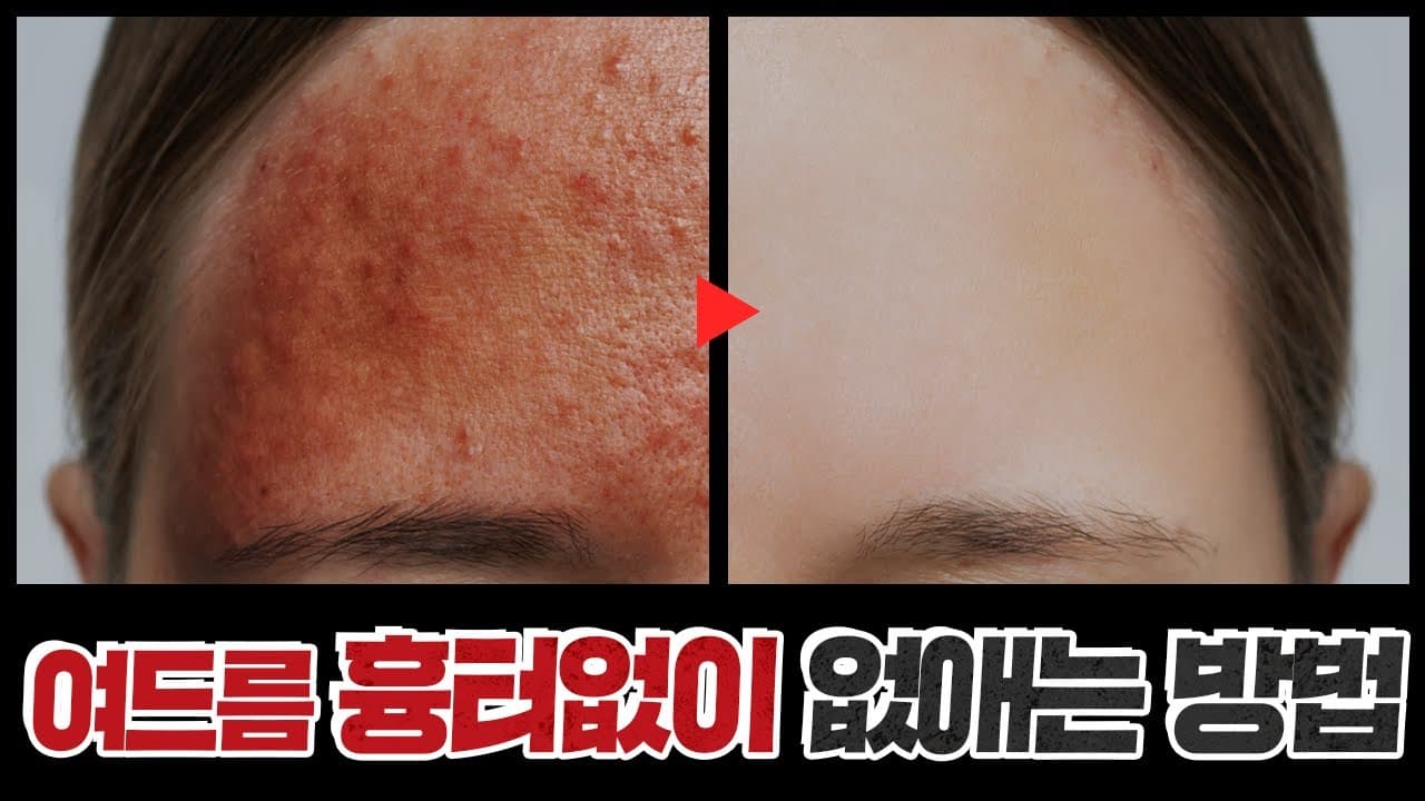 여드름 절대 이렇게 짜지 마세요!