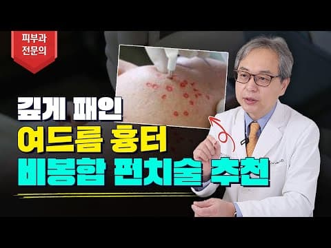 여드름 패인흉터 레이저 치료해도 효과가 없다면? 비봉합 펀치술 알아보기🔎 여드름 흉터 없애는 방법