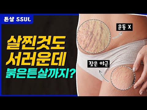 살찐 것도 서러운데… 붉은 튼살까지? 현실 직장인의 고백