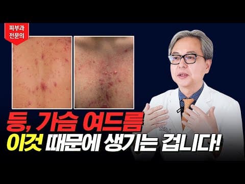 등드름, 가드름 있는 사람들 보세요! 여드름 원인과 치료방법!