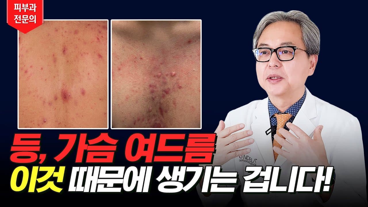 등드름, 가드름 있는 사람들 보세요! 여드름 원인과 치료방법!