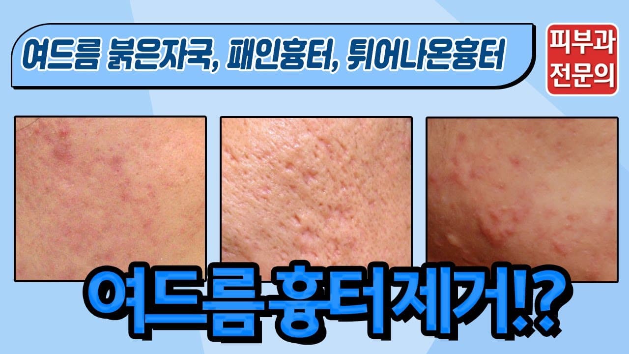 여드름흉터 확실한 치료방법이 알고 싶다면?