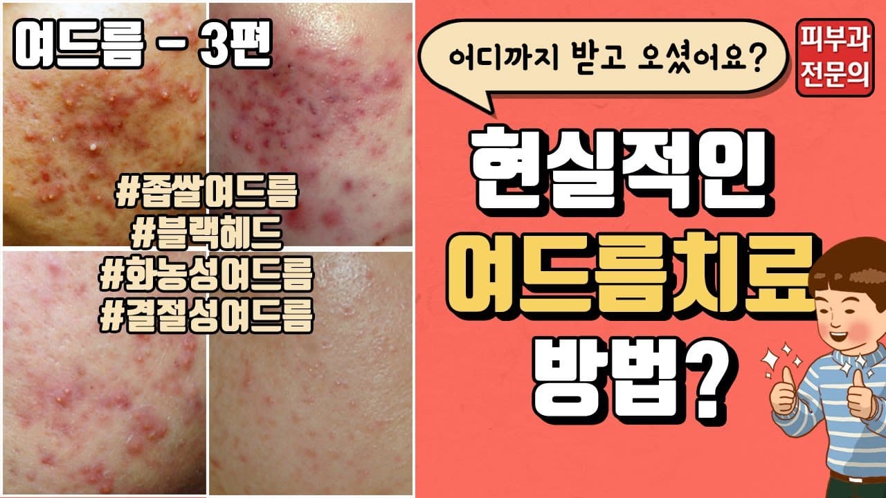 Acne Part 3 Realistic Acne Treatments Anti Inflammatory Injections And Oral Medication