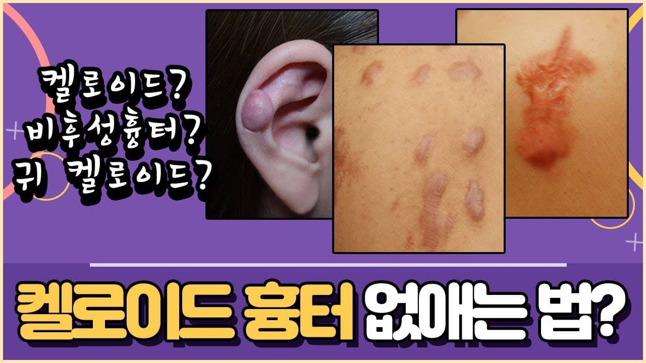 ケロイド傷跡を消す方法?(ケロイドの原因、予防、治療法まで)