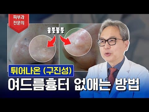 코에 튀어나온 구진성 여드름흉터 제거 가능할까?