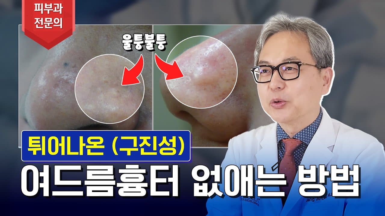 Papular Acne Scars On The Nose: Can They Be Removed?