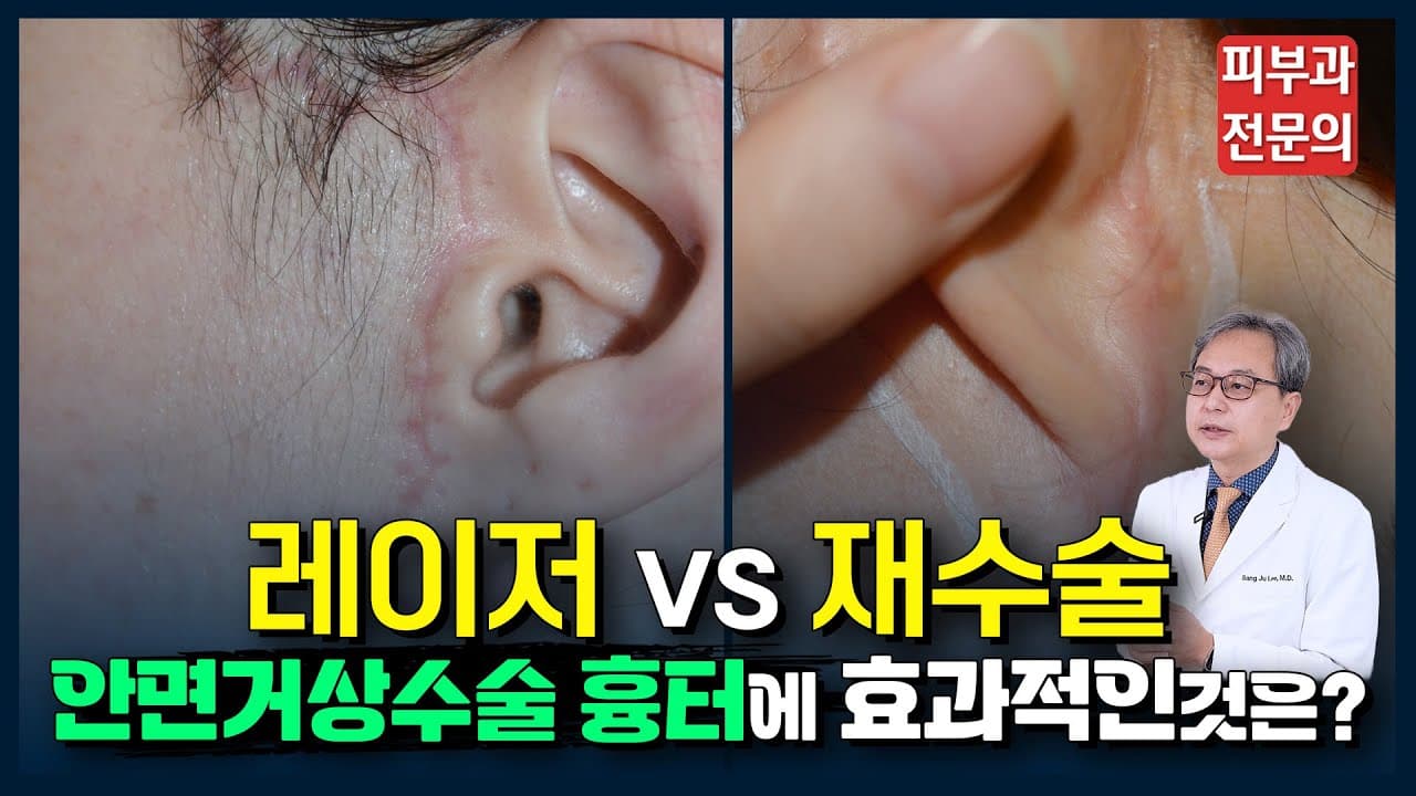 Facelift Surgery Scar Laser Versus Revision Surgery Compared
