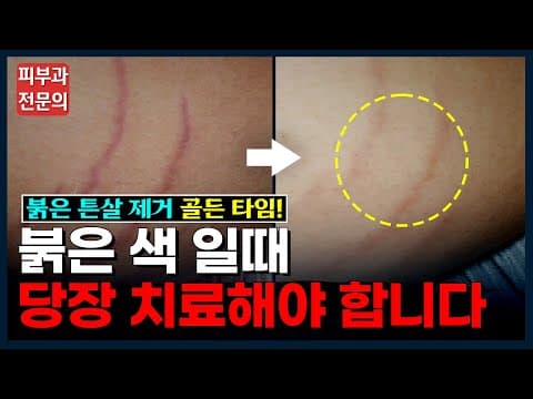 🚨 붉은 튼살 🚨 지금 바로 치료 해야 하는 이유‼ 정확하게 알려드립니다 | 붉은 튼살 없애기, 레이저, 크림, 연고