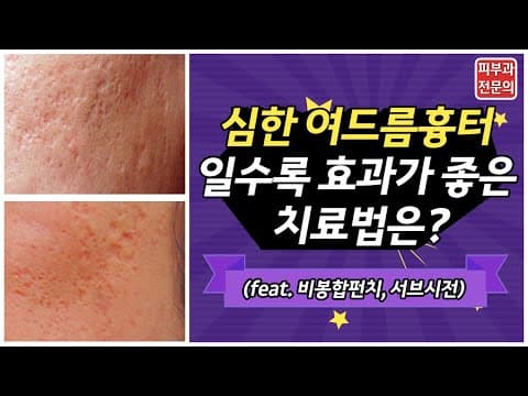 여드름흉터제거, 치료 효과가 없었다면? (비봉합펀치,서브시전)