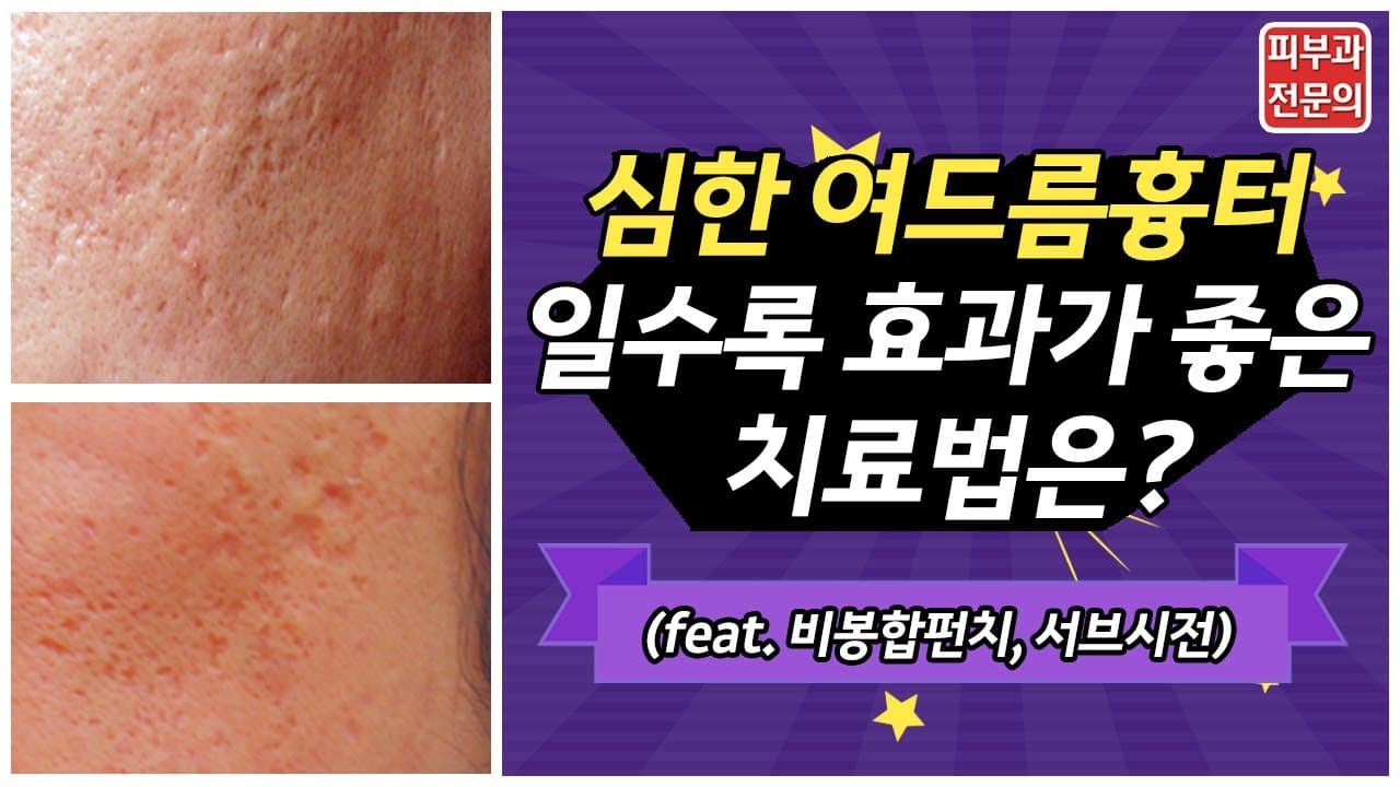 여드름흉터제거, 치료 효과가 없었다면? (비봉합펀치,서브시전)