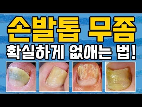손발톱 무좀? 낫고 싶다면 드루와