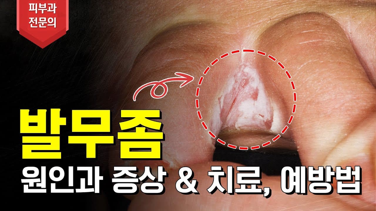 彻底解决恼人的脚气,马上告诉你脚气的解决方法!