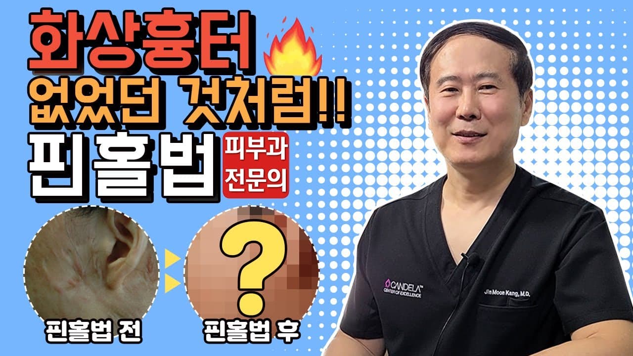 Learn About The Pinhole Method To Make Burn Scars Disappear