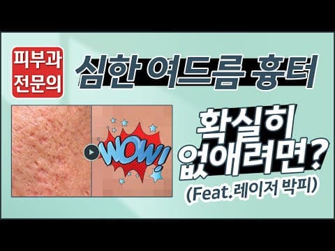 심한 여드름 흉터 확실히 없애는법?(feat.레이저 박피)