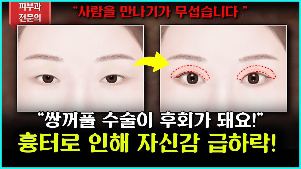 Double Eyelid Surgery Scars Can Absolutely Be Treated: Regain Confidence