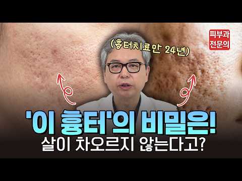 아무리 좋은 치료를 받아도 여드름 흉터가 그대로라면? 밑에서 당기는 '이것'부터 끊으세요