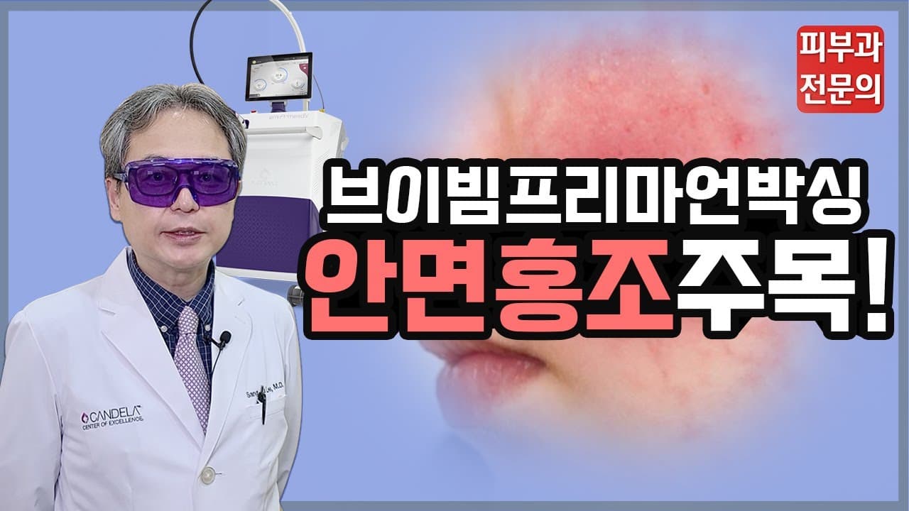 안면홍조 없애는 법 | 브이빔 레이저 후기 (faet. 브이빔 프리마)
