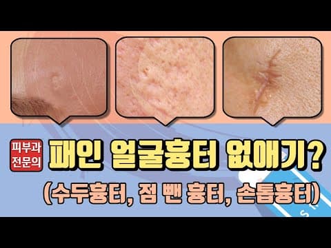 심한 얼굴흉터 없애는 법? (수두흉터, 대상포진, 손톱흉터)