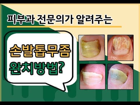 발톱무좀치료, 완치법? (원인,레이저,핀포인트,먹는약,없애는법,자가관리까지)
