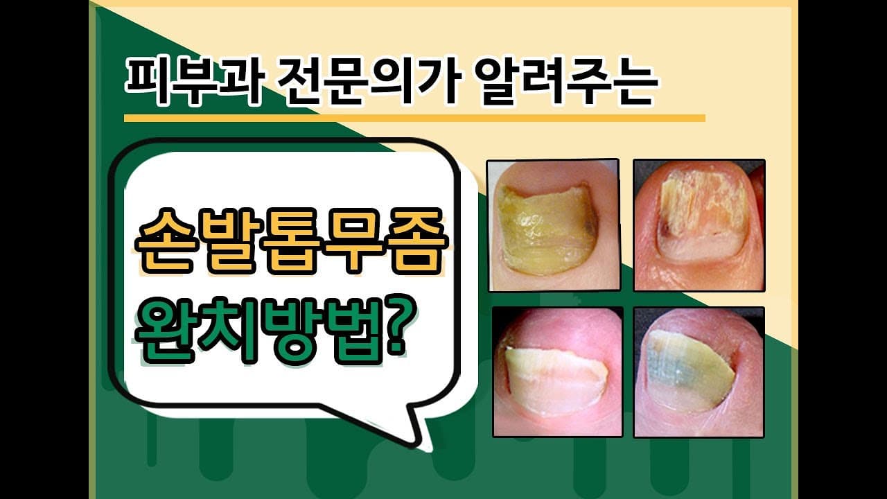 爪水虫治療、完治法?(原因、レーザー、ピンポイント、内服薬、除去法、セルフケアまで)