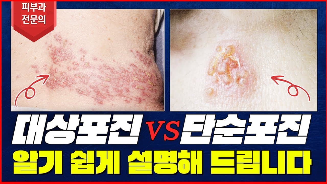 Herpes Simplex Versus Shingles Differences Treatment And Contagion