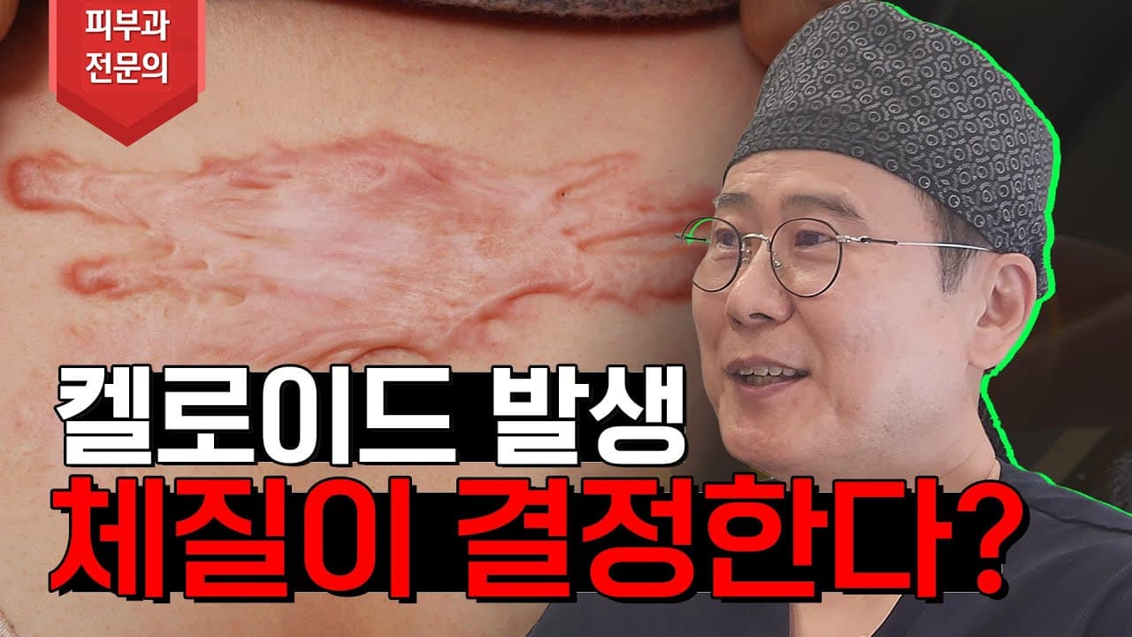 Why Do Keloids Form? You Watching This Might Be Prone Too